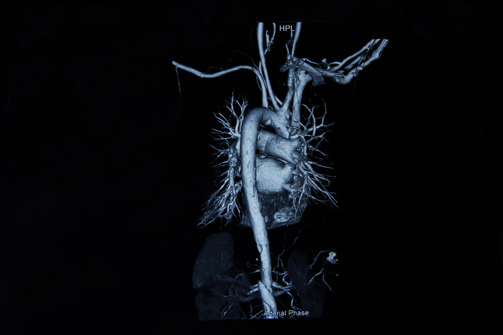 Do You Have Plaque in Your Arteries? CT Angiogram with Cleerly Will Let You Know