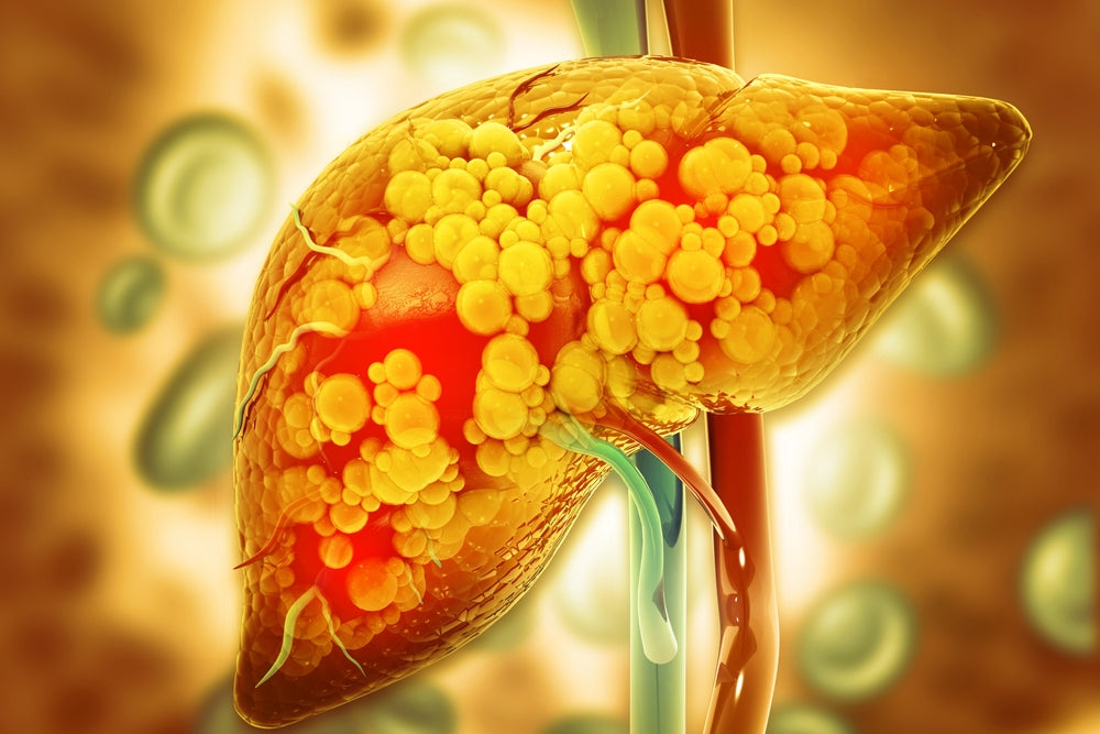 Fatty Liver: Causes, Diagnosis, Risk Factors, and Integrative Treatments That Work