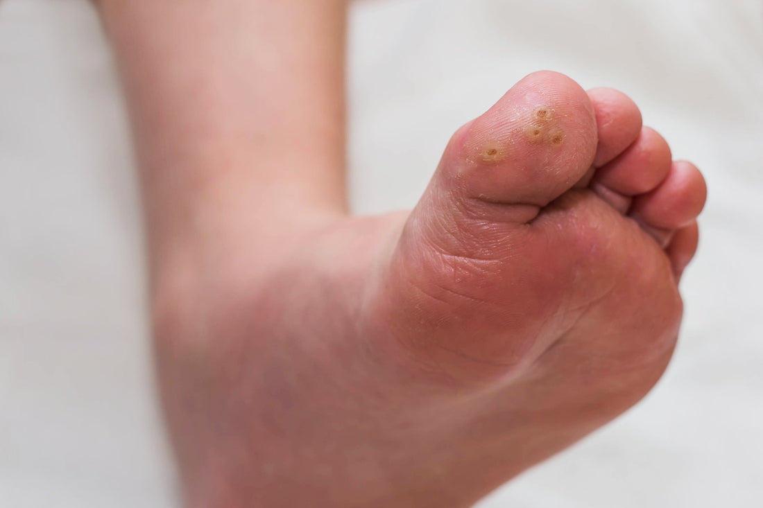 How to Treat Plantar Warts - Revolution Style