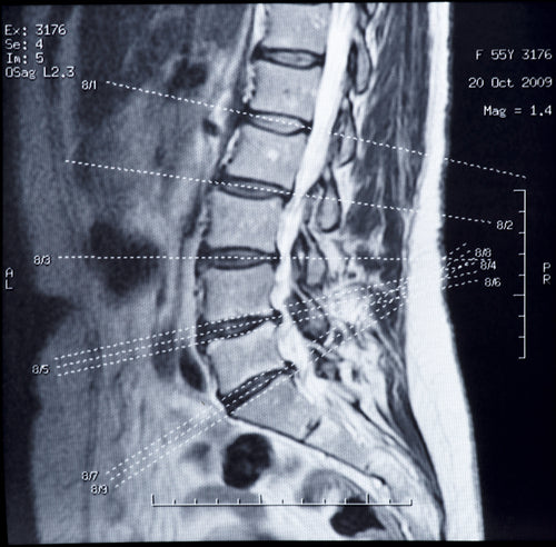 MRI For Musculoskeletal Pain Is Often Not Helpful